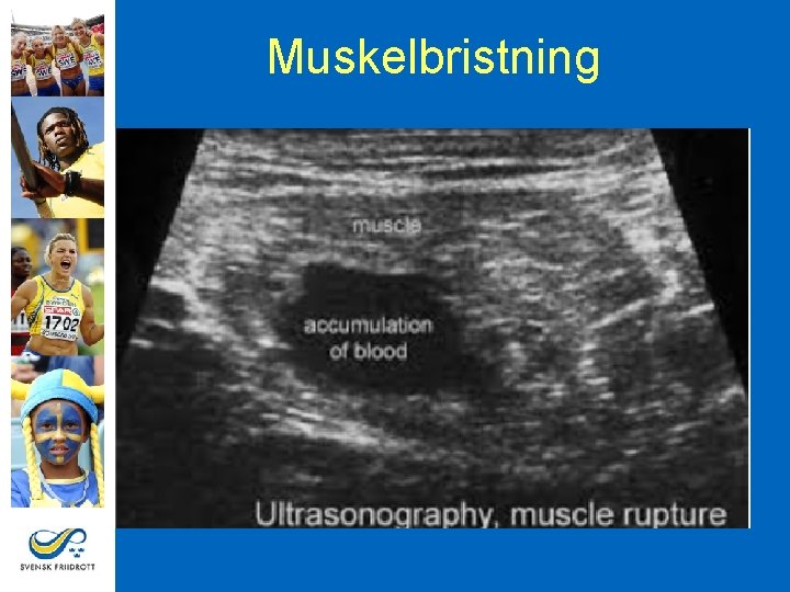 Muskelbristning 