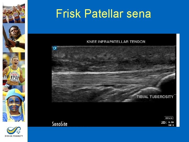 Frisk Patellar sena 