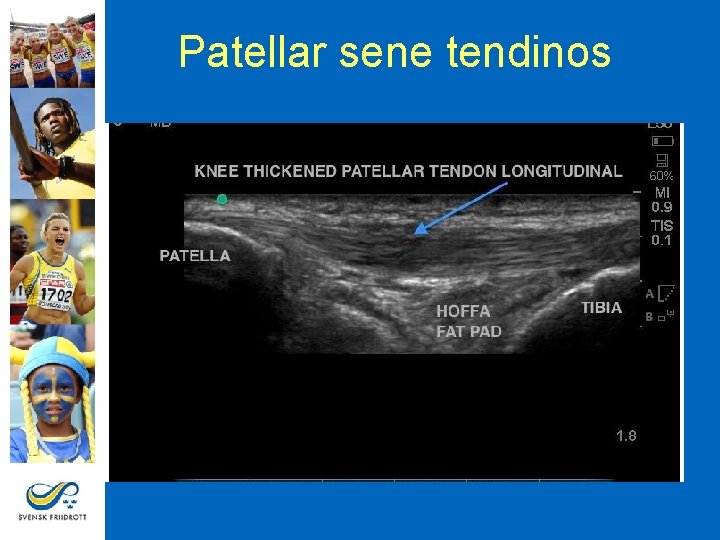Patellar sene tendinos 