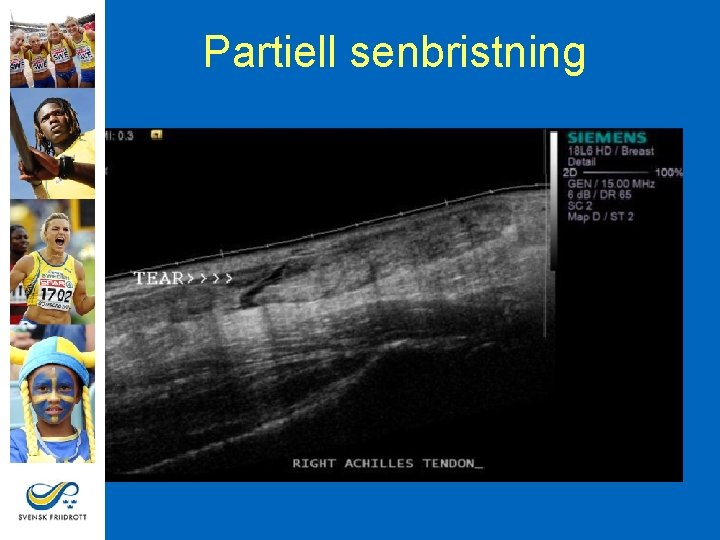 Partiell senbristning 