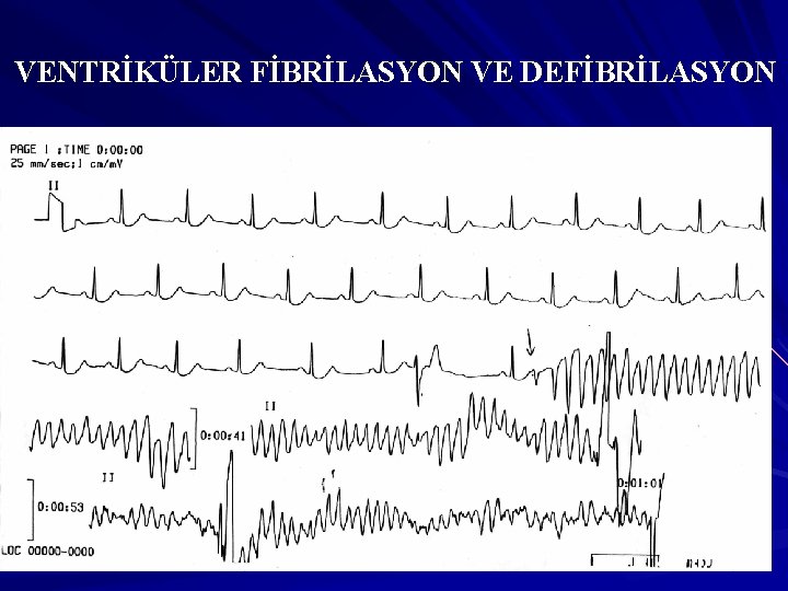 VENTRİKÜLER FİBRİLASYON VE DEFİBRİLASYON 