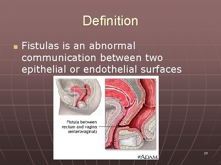 Definition n Fistulas is an abnormal communication between two epithelial or endothelial surfaces 29