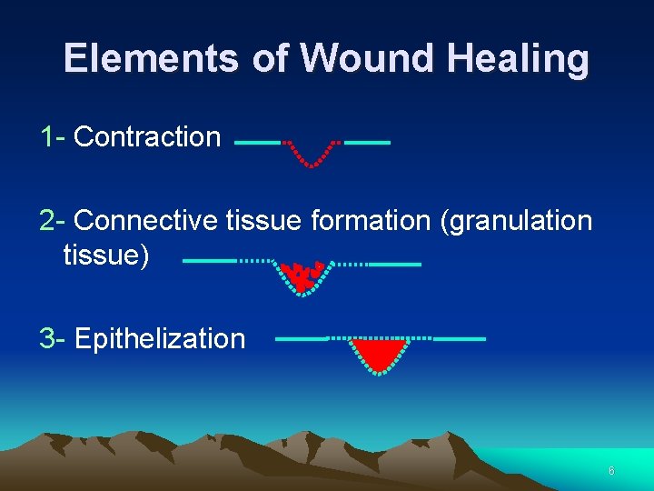 Elements of Wound Healing 1 - Contraction 2 - Connective tissue formation (granulation tissue)