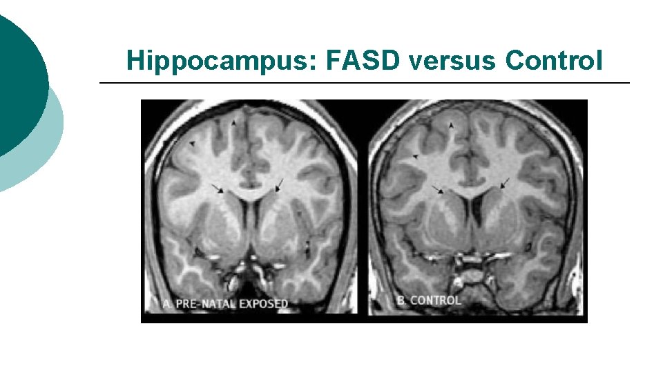 Hippocampus: FASD versus Control 