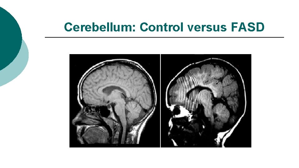 Cerebellum: Control versus FASD 