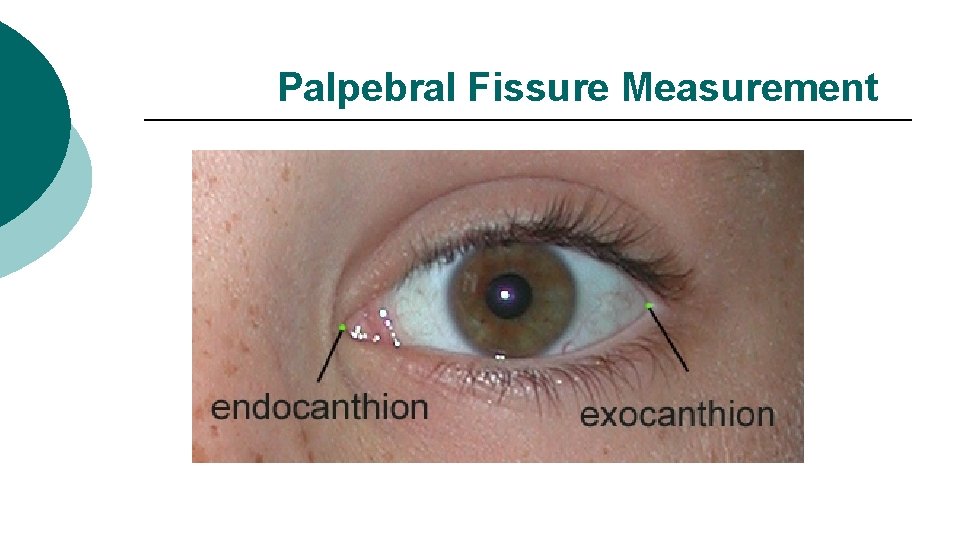 Palpebral Fissure Measurement 