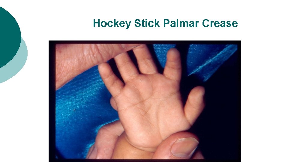 Hockey Stick Palmar Crease 