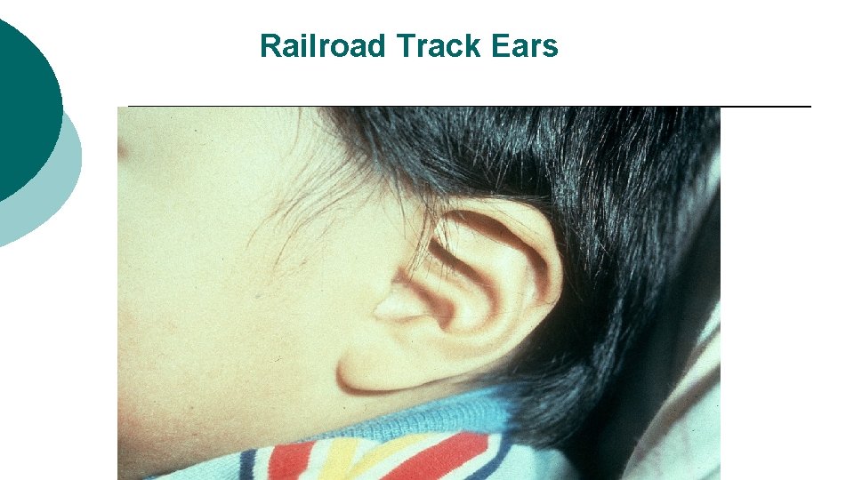 Railroad Track Ears 
