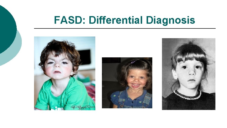 FASD: Differential Diagnosis 