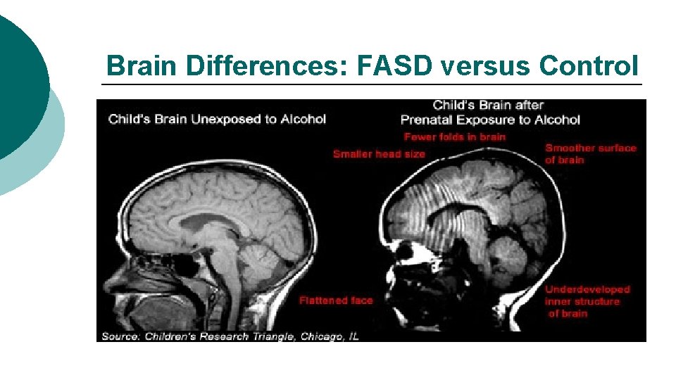 Brain Differences: FASD versus Control 