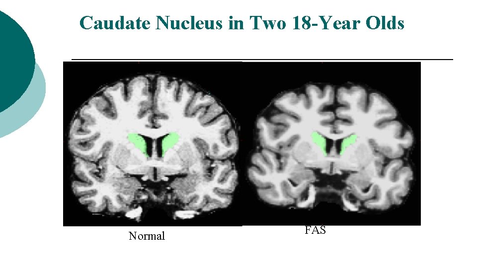 Caudate Nucleus in Two 18 -Year Olds Normal FAS 