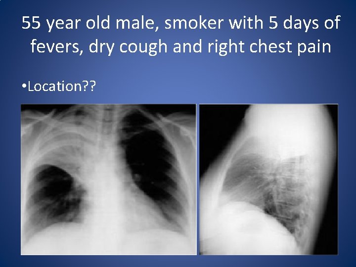 55 year old male, smoker with 5 days of fevers, dry cough and right