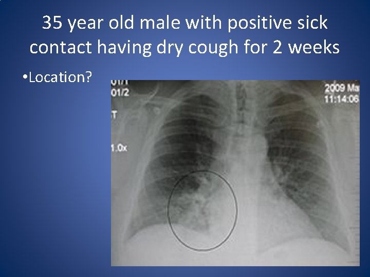 35 year old male with positive sick contact having dry cough for 2 weeks