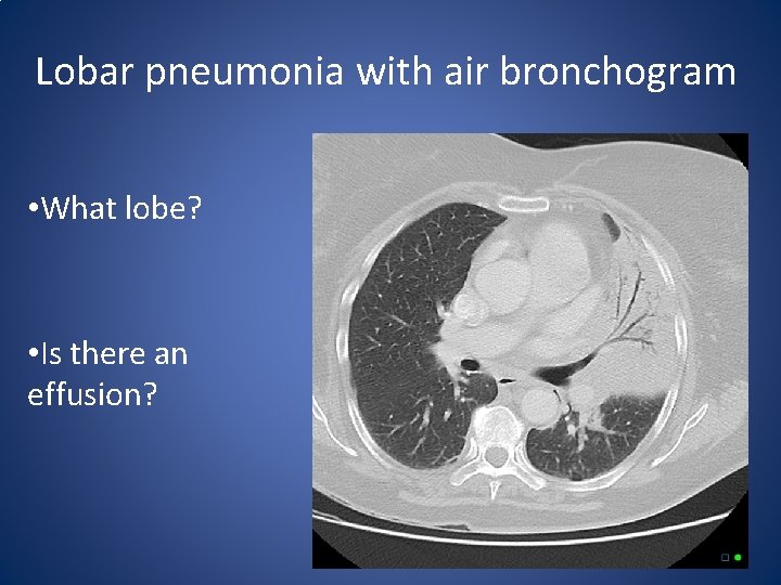 Lobar pneumonia with air bronchogram • What lobe? • Is there an effusion? 