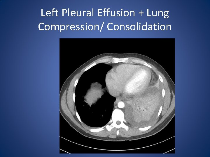 Left Pleural Effusion + Lung Compression/ Consolidation 