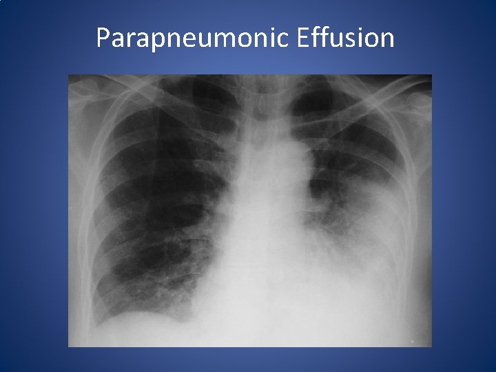 Parapneumonic Effusion 