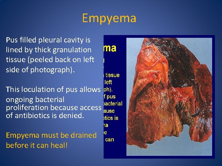 Empyema Pus filled pleural cavity is lined by thick granulation tissue (peeled back on