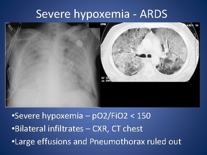 Severe hypoxemia - ARDS • Severe hypoxemia – p. O 2/Fi. O 2 <