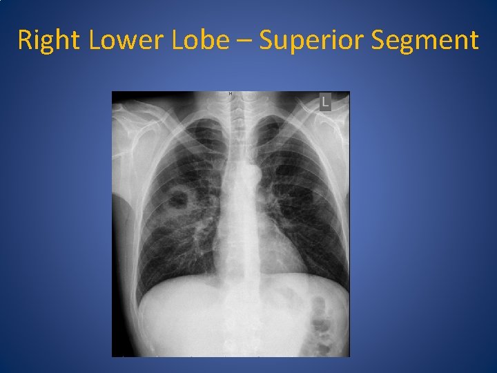 Right Lower Lobe – Superior Segment 