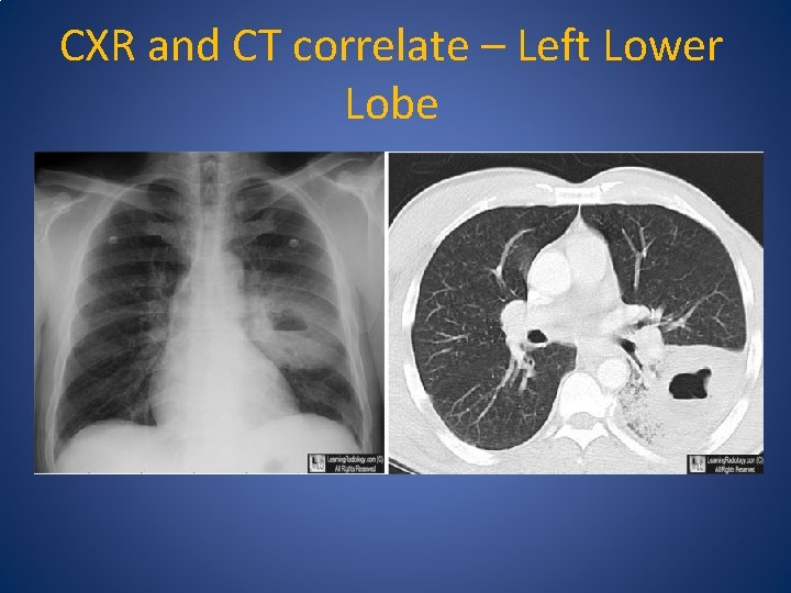 CXR and CT correlate – Left Lower Lobe 