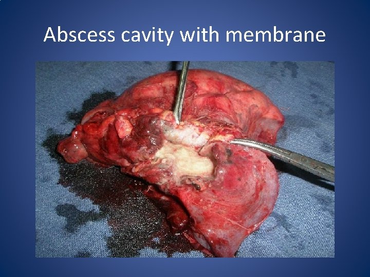 Abscess cavity with membrane 