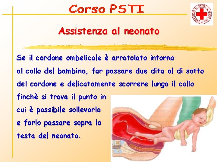 Assistenza al neonato Se il cordone ombelicale è arrotolato intorno al collo del bambino,