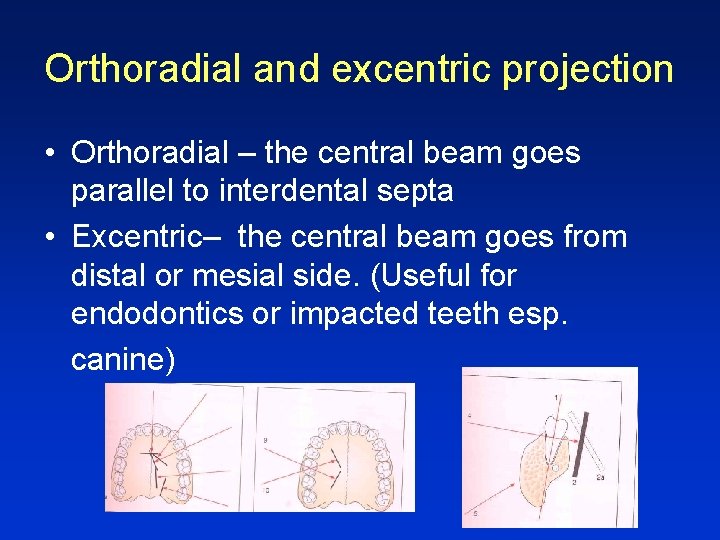 Orthoradial and excentric projection • Orthoradial – the central beam goes parallel to interdental