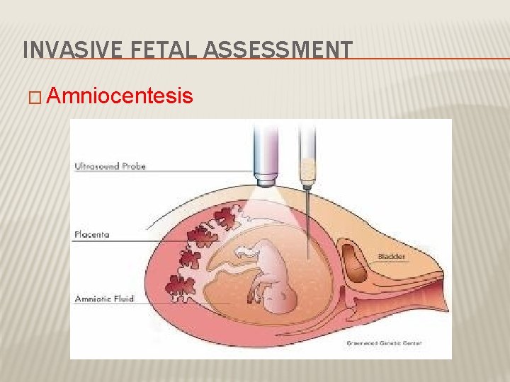 INVASIVE FETAL ASSESSMENT � Amniocentesis 