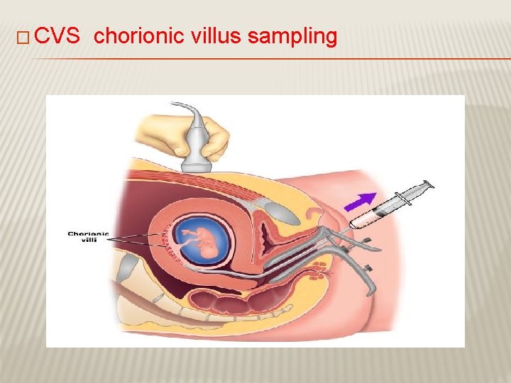 � CVS chorionic villus sampling 