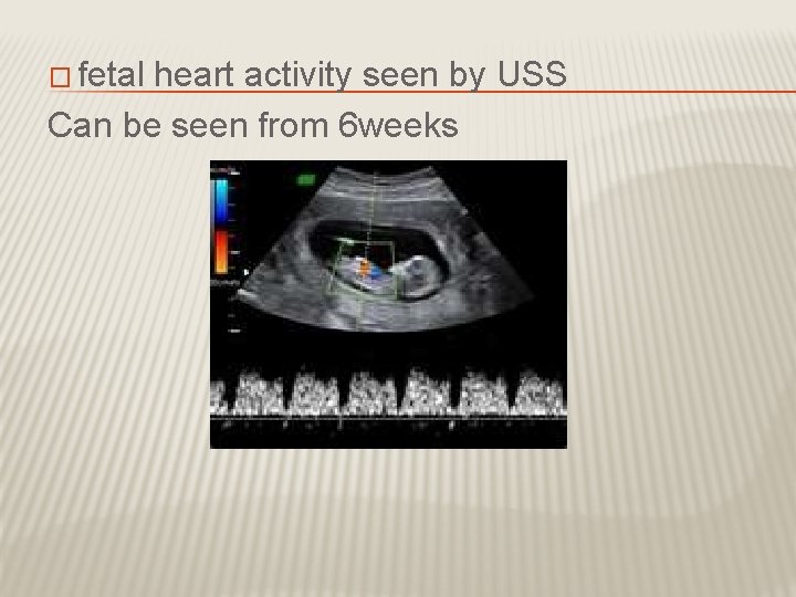 � fetal heart activity seen by USS Can be seen from 6 weeks 