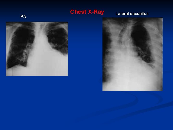 PA Chest X-Ray Lateral decubitus 