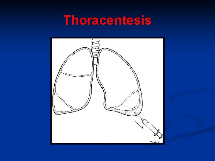 Thoracentesis 