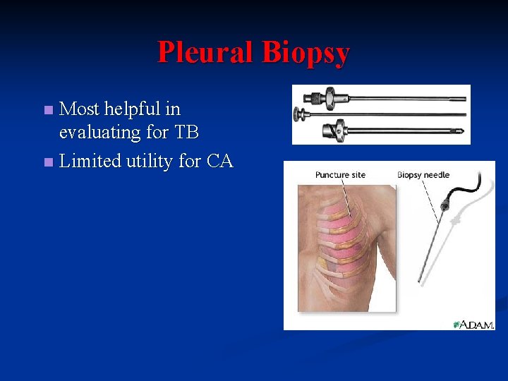 Pleural Biopsy Most helpful in evaluating for TB n Limited utility for CA n