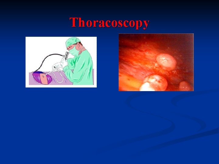 Thoracoscopy 