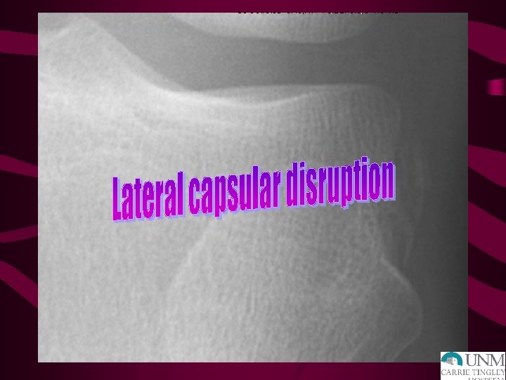 LIGAMENT INJURIES: XRAY • AP – Lateral capsular sign: Segond fx – Tibial spine