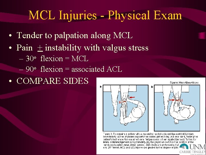 MCL Injuries - Physical Exam • Tender to palpation along MCL • Pain +