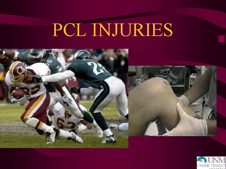 PCL INJURIES • Mechanism – Sports = fall on flexed knee with foot plantarflexed,