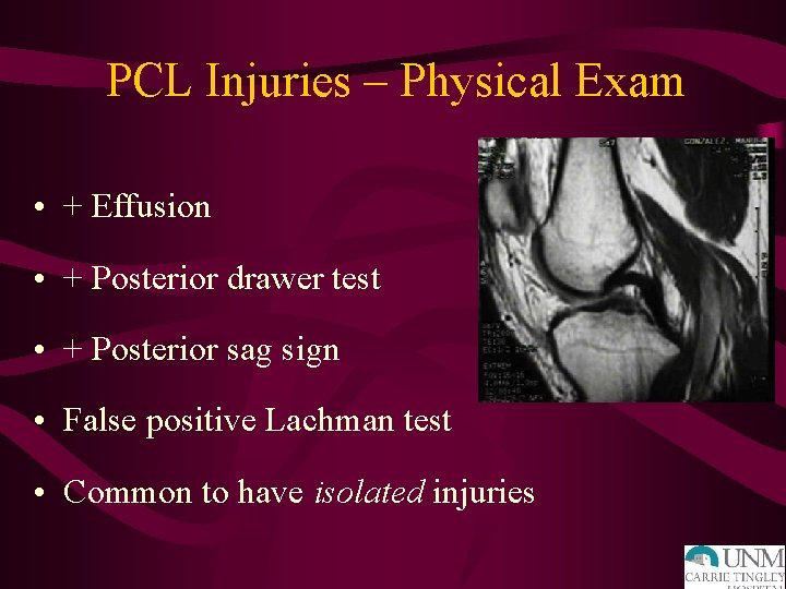 PCL Injuries – Physical Exam • + Effusion • + Posterior drawer test •