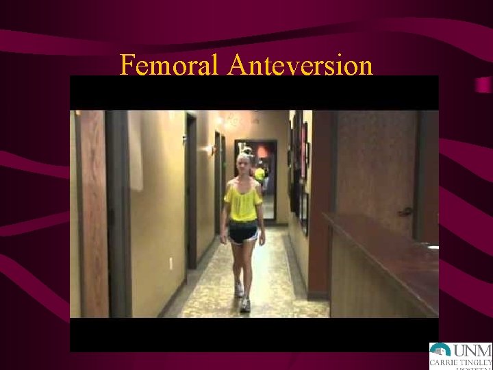 Femoral Anteversion 