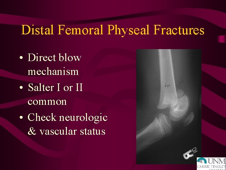 Distal Femoral Physeal Fractures • Direct blow mechanism • Salter I or II common