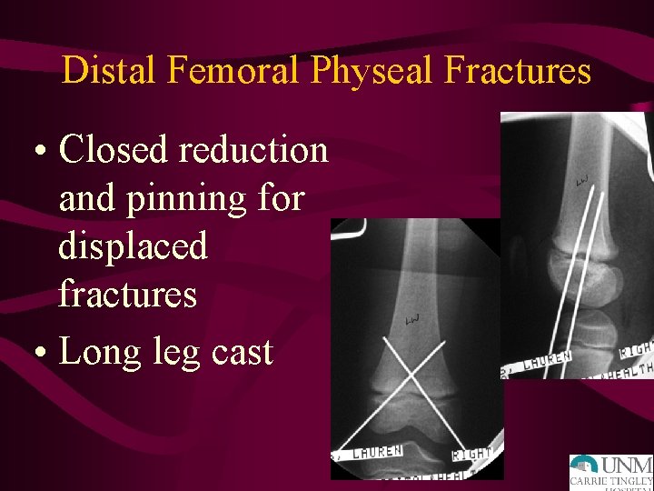 Distal Femoral Physeal Fractures • Closed reduction and pinning for displaced fractures • Long