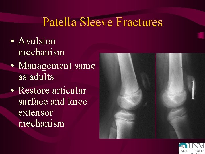 Patella Sleeve Fractures • Avulsion mechanism • Management same as adults • Restore articular