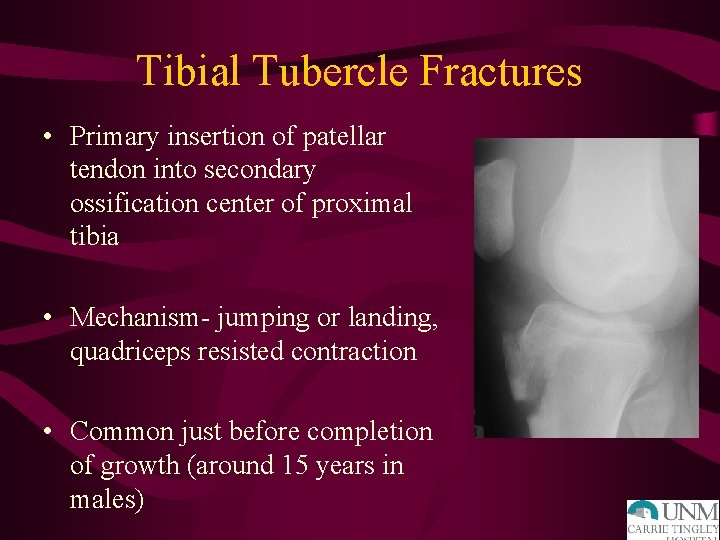 Tibial Tubercle Fractures • Primary insertion of patellar tendon into secondary ossification center of