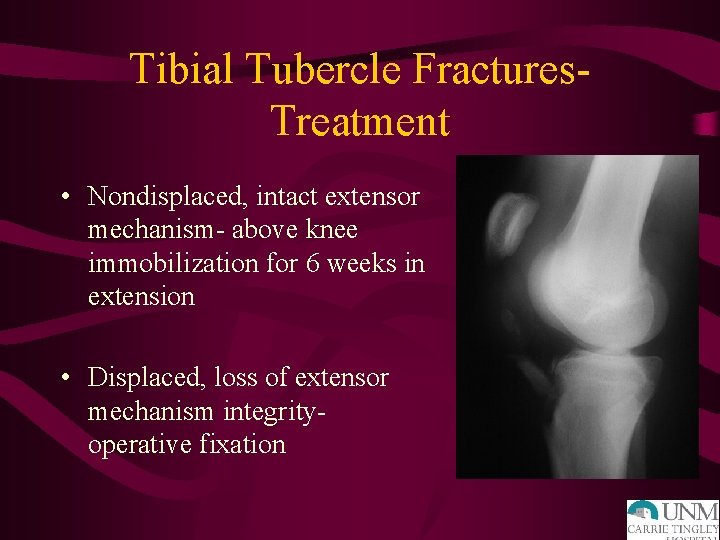 Tibial Tubercle Fractures. Treatment • Nondisplaced, intact extensor mechanism- above knee immobilization for 6