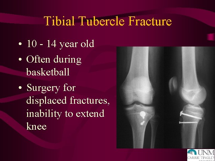 Tibial Tubercle Fracture • 10 - 14 year old • Often during basketball •