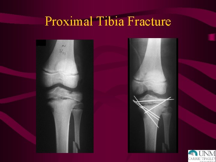 Proximal Tibia Fracture 