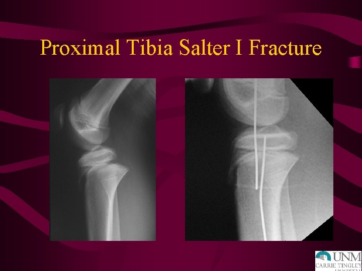 Proximal Tibia Salter I Fracture 