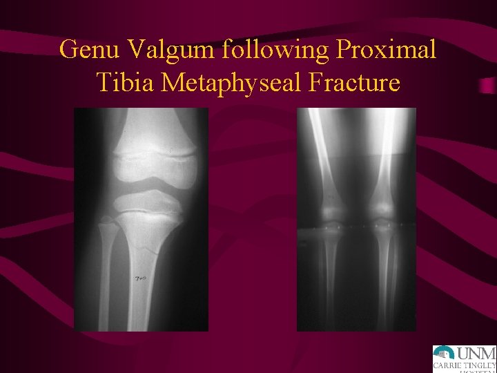 Genu Valgum following Proximal Tibia Metaphyseal Fracture 