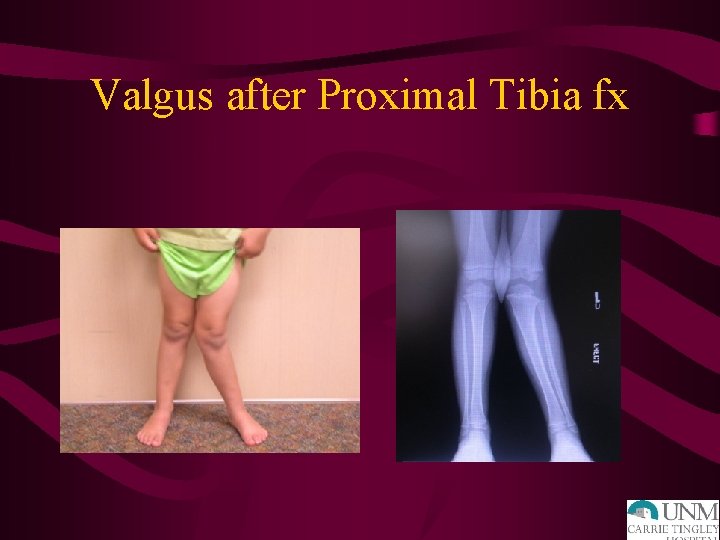 Valgus after Proximal Tibia fx 