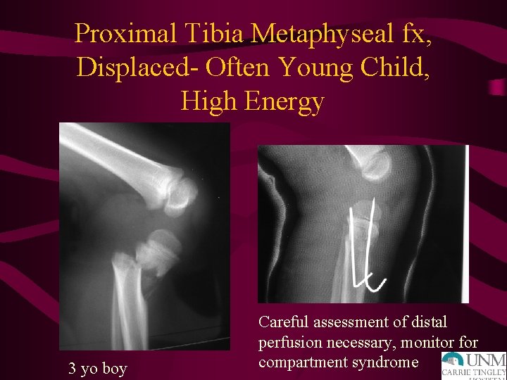 Proximal Tibia Metaphyseal fx, Displaced- Often Young Child, High Energy 3 yo boy Careful